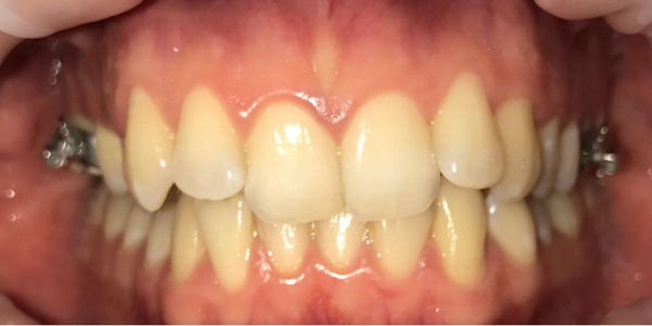 Лечение прикуса и скученности зубов на брекетах - фото до