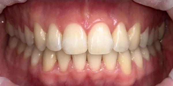 Лечение прикуса и скученности зубов на брекетах - фото после