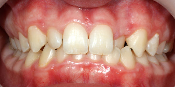 Выравнивание зубов брекетами - фото до