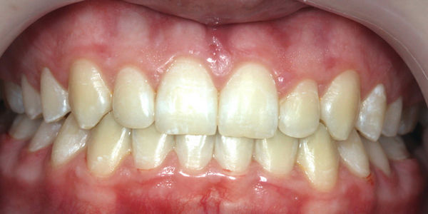 Выравнивание зубов брекетами - фото после