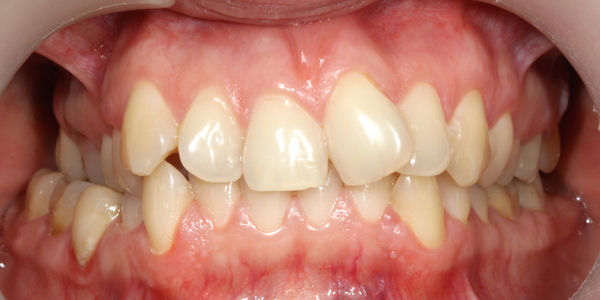 Комплексное ортодонтическое лечение - фото до
