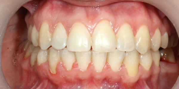 Комплексное ортодонтическое лечение - фото после