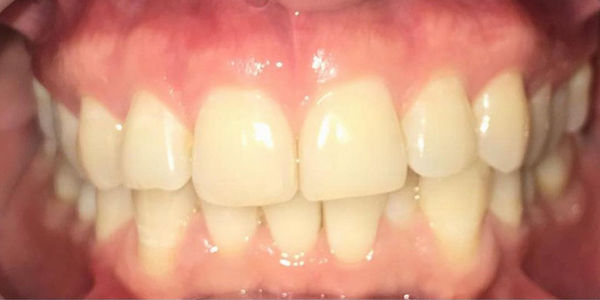 Устранение скученности зубов элайнерами - фото до