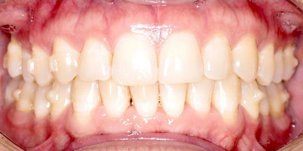 Устранение скученности зубов элайнерами - фото после