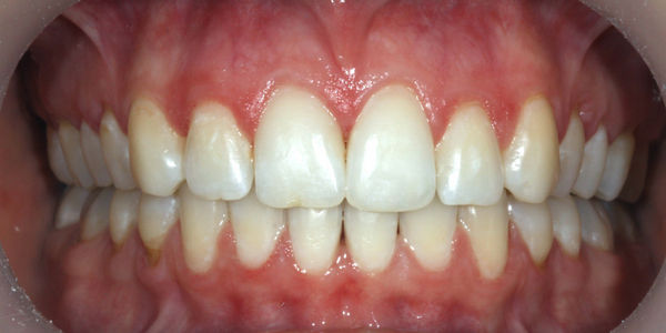 Ортодонтическая реабилитация с помощью брекетов - фото до